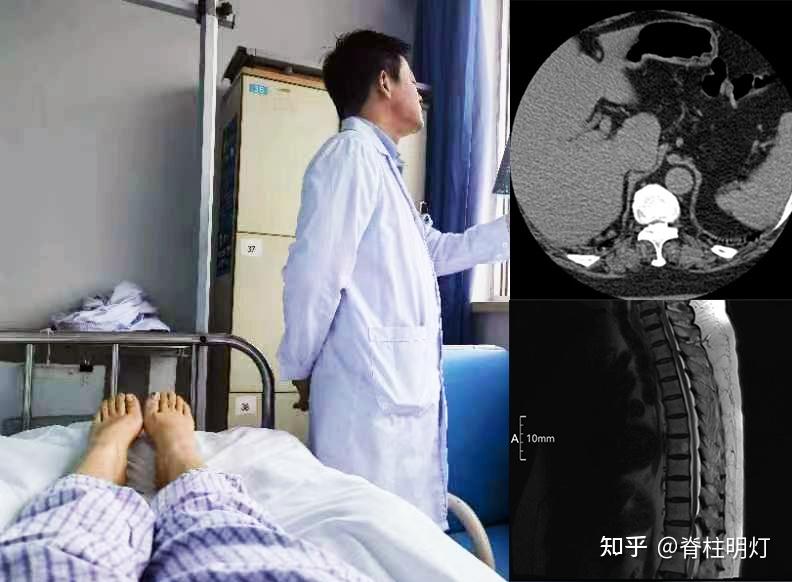 毛宁方团队UBE微创技术为复杂型胸椎管狭窄患者带来福音 - 知乎