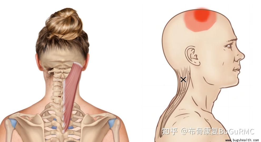 颈夹肌激痛点图片