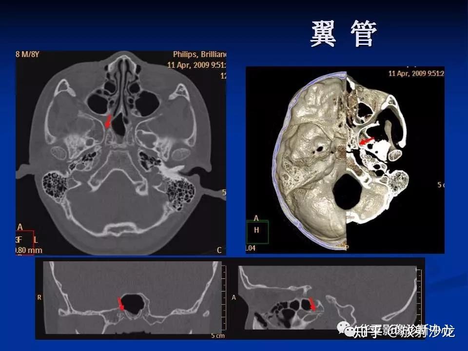 实用,详细的颅底各孔道影像解剖!