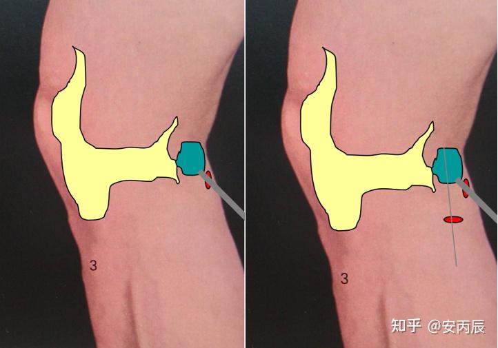 腘窝囊肿的诊治要点 - 知乎