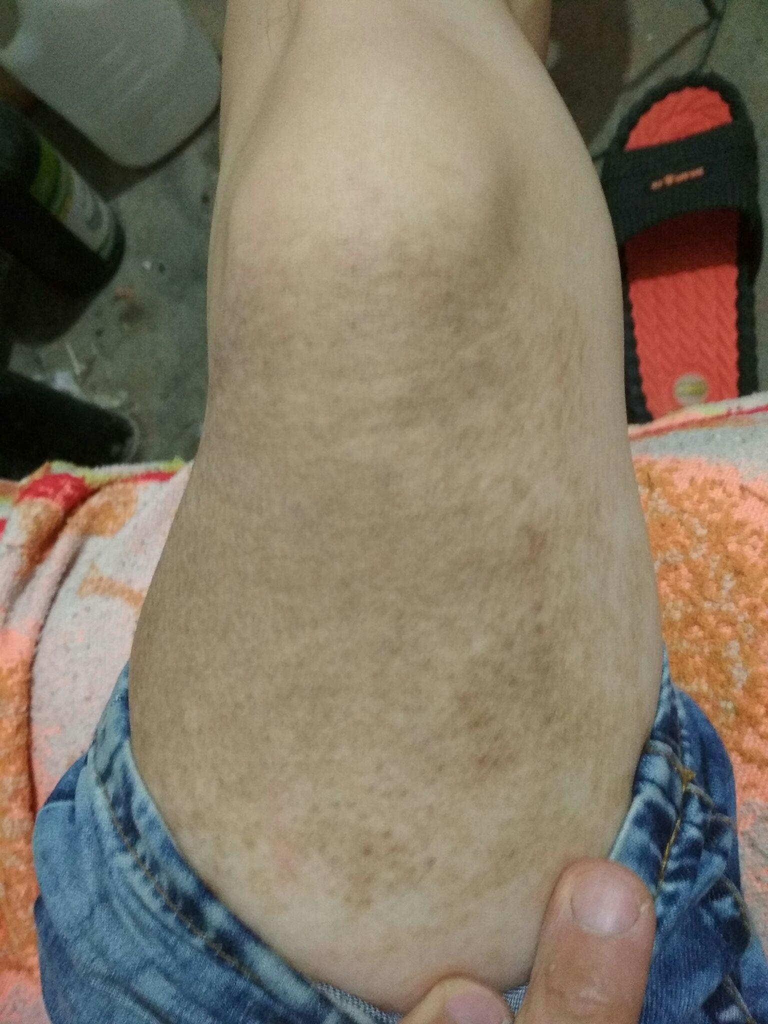 大概在十五六岁的时候吧,腿上长出这些黑斑,有黑色的汗毛,不知道是