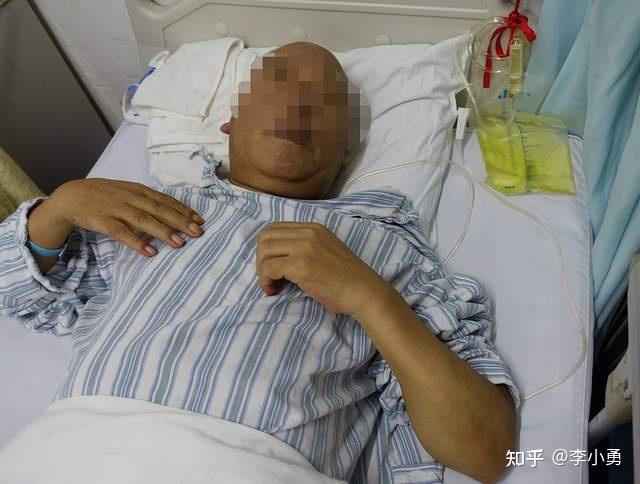 老年正常压力性脑积水:痴呆,日常生活不能自理,走路特别缓慢且小碎步