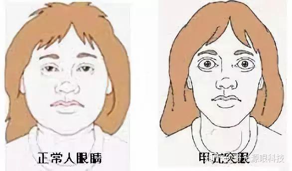 近视戴眼镜真的会导致眼睛变凸吗