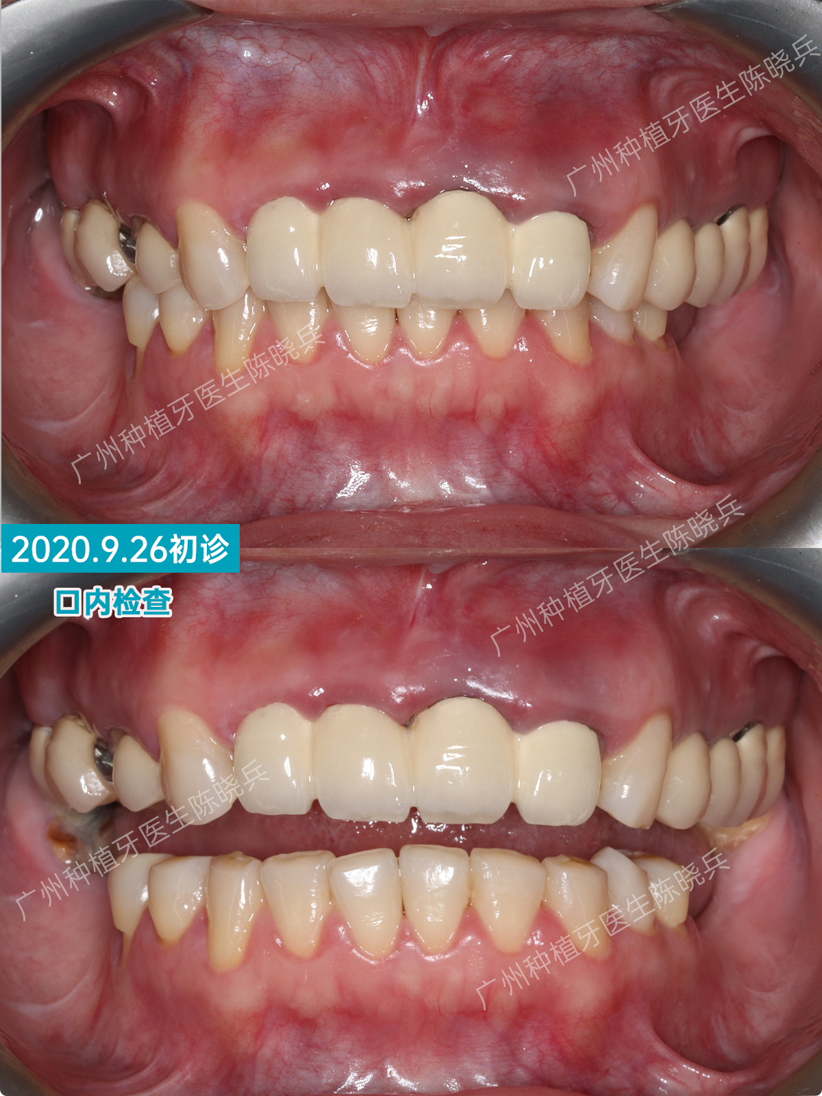 目前已经进行到三期取模,两周后就可以戴冠,后续再处理其他牙齿