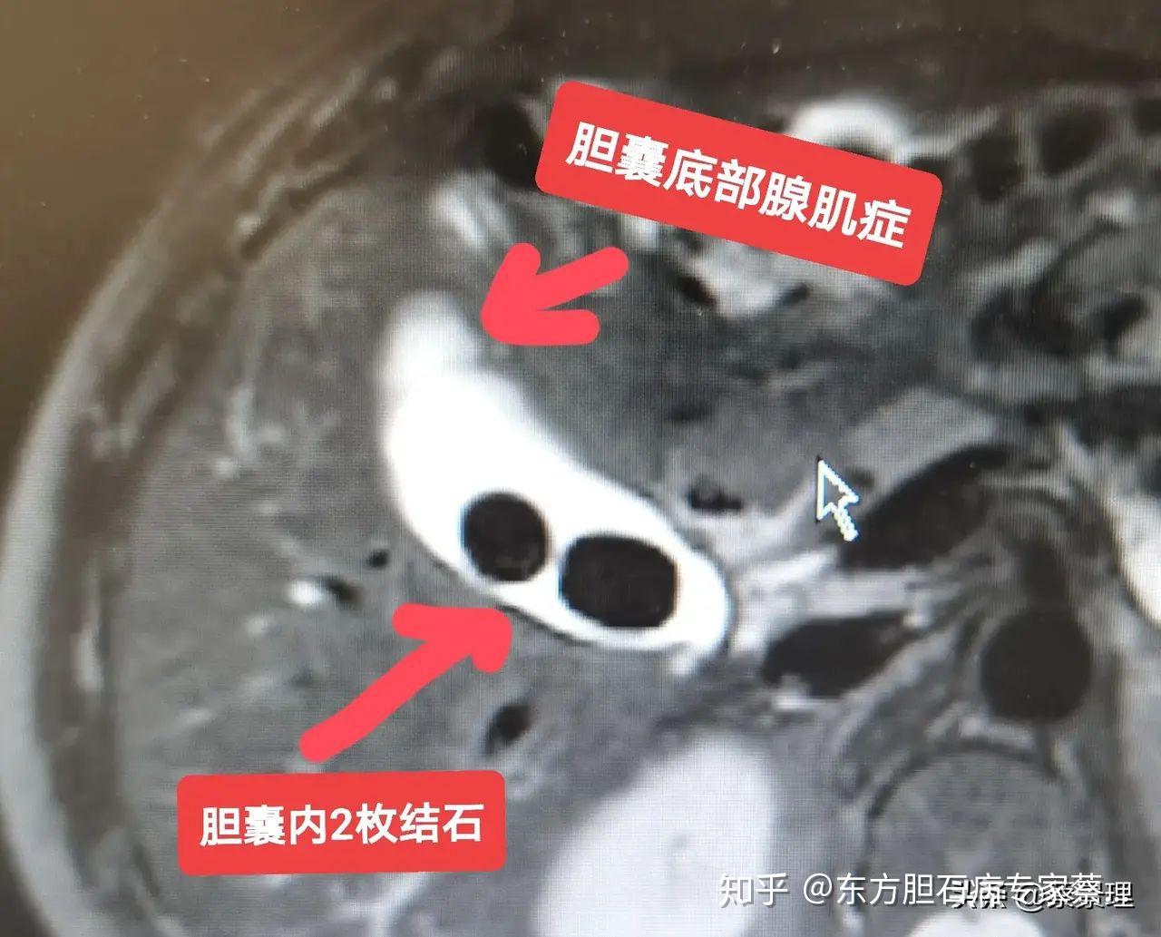 膽囊結石合併膽囊腺肌症可以保膽嗎