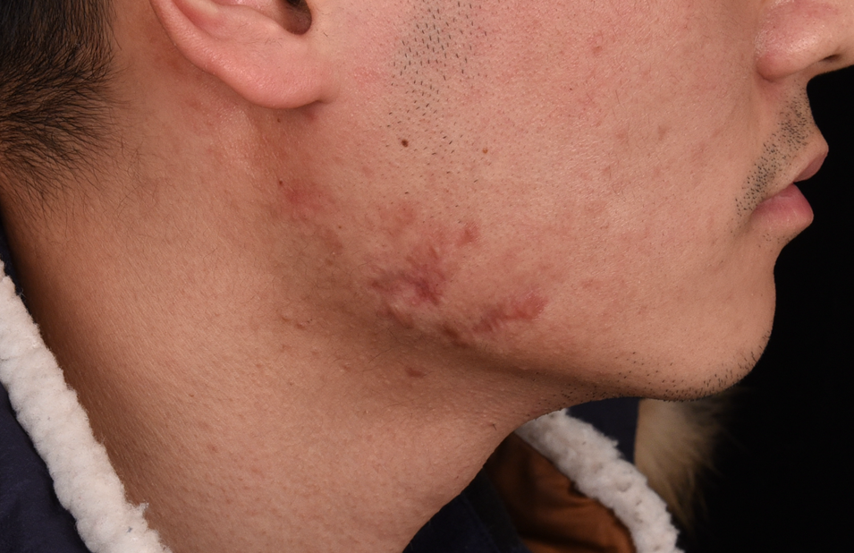 疤痕针封闭针疤痕软化针的作用及其危害