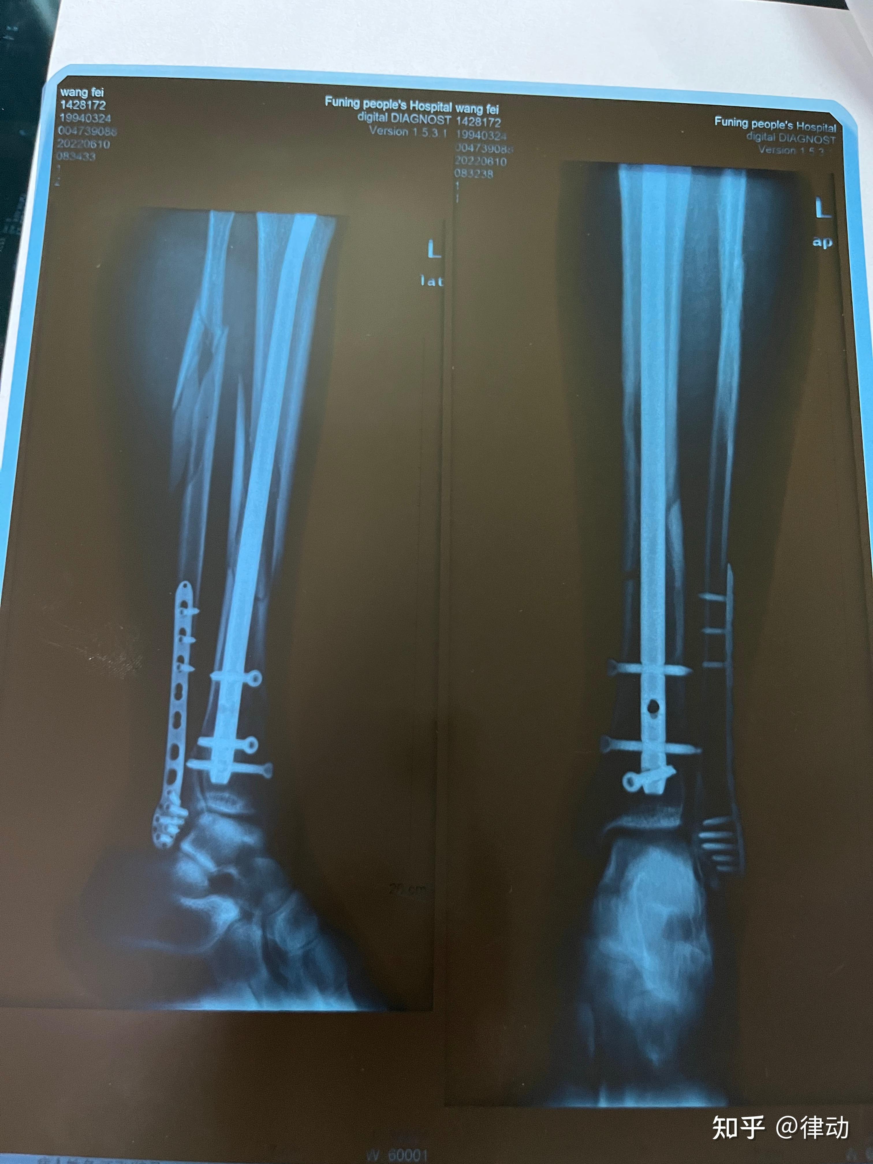 小腿骨折x光片图片