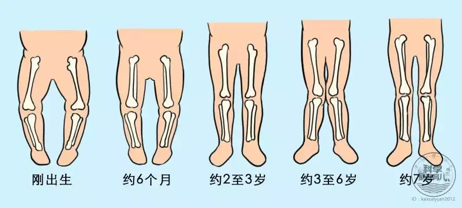 伴随生理性o型腿:因为空间问题,胎儿在妈妈腹中蜷缩,腿骨会轻微的弯曲