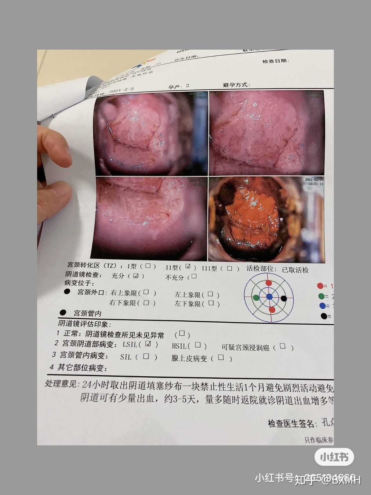 hpv阴道镜报告能帮忙看看吗
