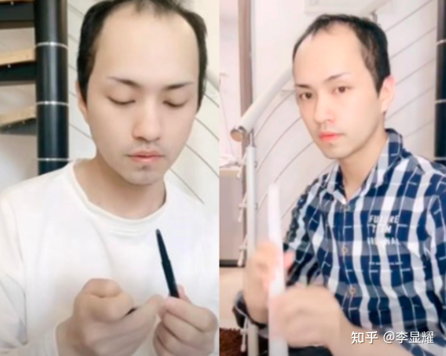 发际线的重要性,你到底了解多少?