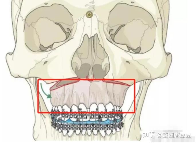 决定做正颌手术前,你必须了解的3点功课!手术方式、风险、医生! - 知乎
