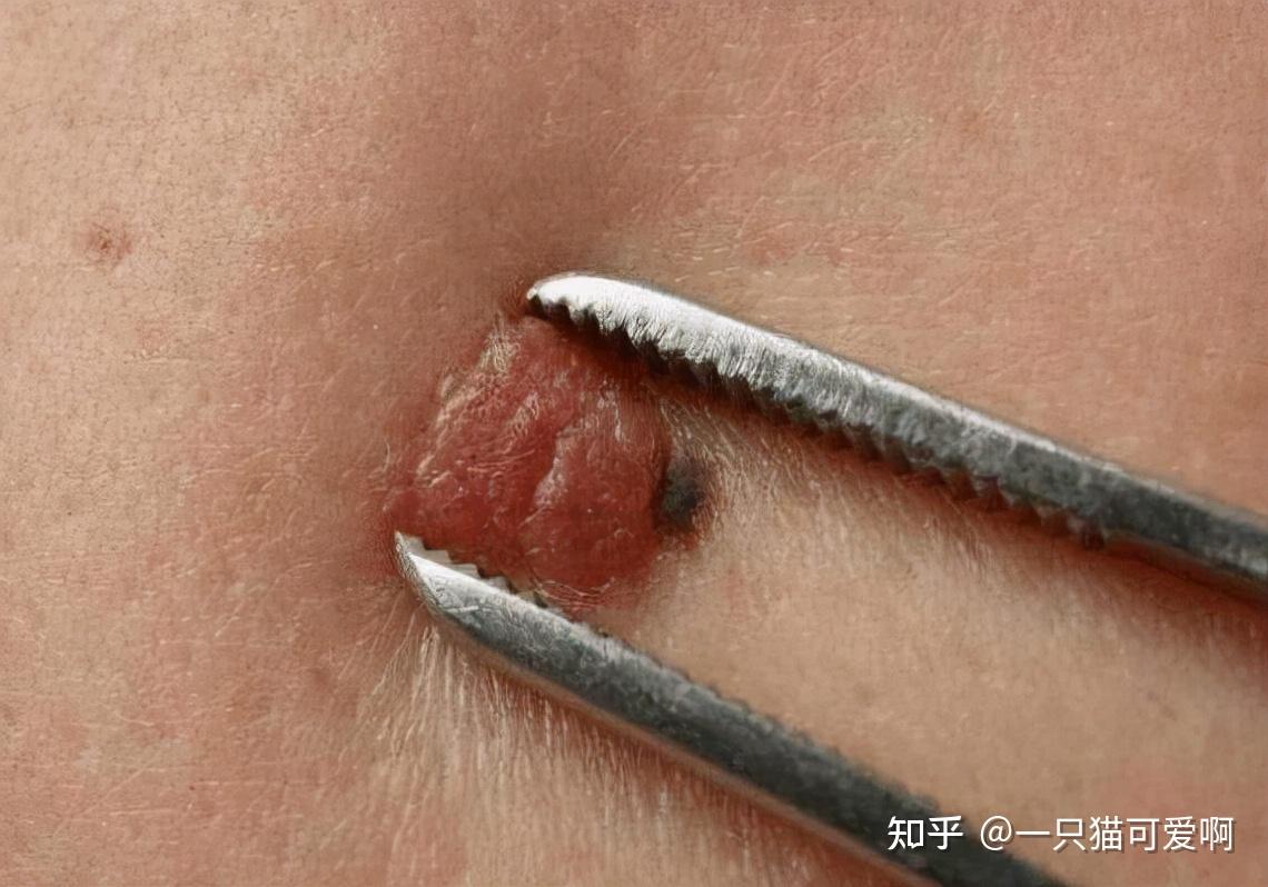 身上若出现3处地方"发痒",或是hpv病毒,别不当一回事 - 知乎