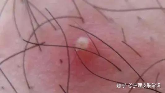 【肤康·科普】毛囊炎有哪些表现?是什么原因引起的呢? - 知乎
