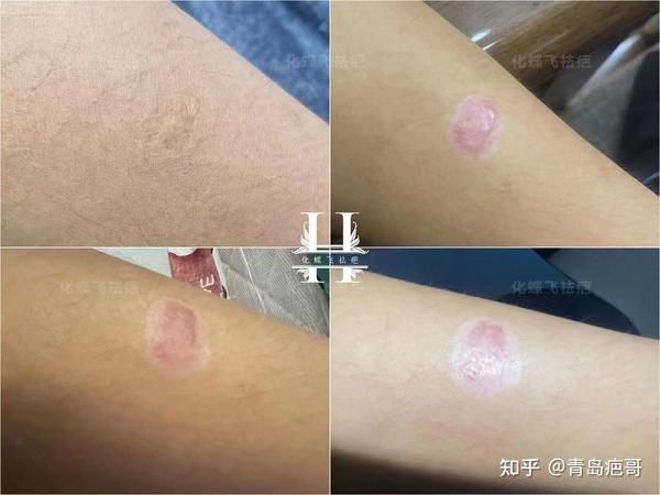 烟头烫伤疤痕 - 知乎
