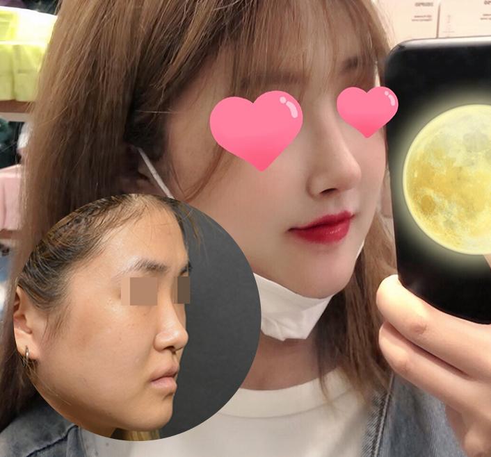 angelababy 新剧鼻子又透光,就是隆鼻了吗?看完我的分析就明白了!