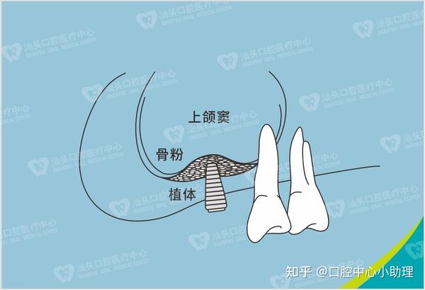 种牙骨量不足该怎么办?目前有哪些植骨技术? - 知乎