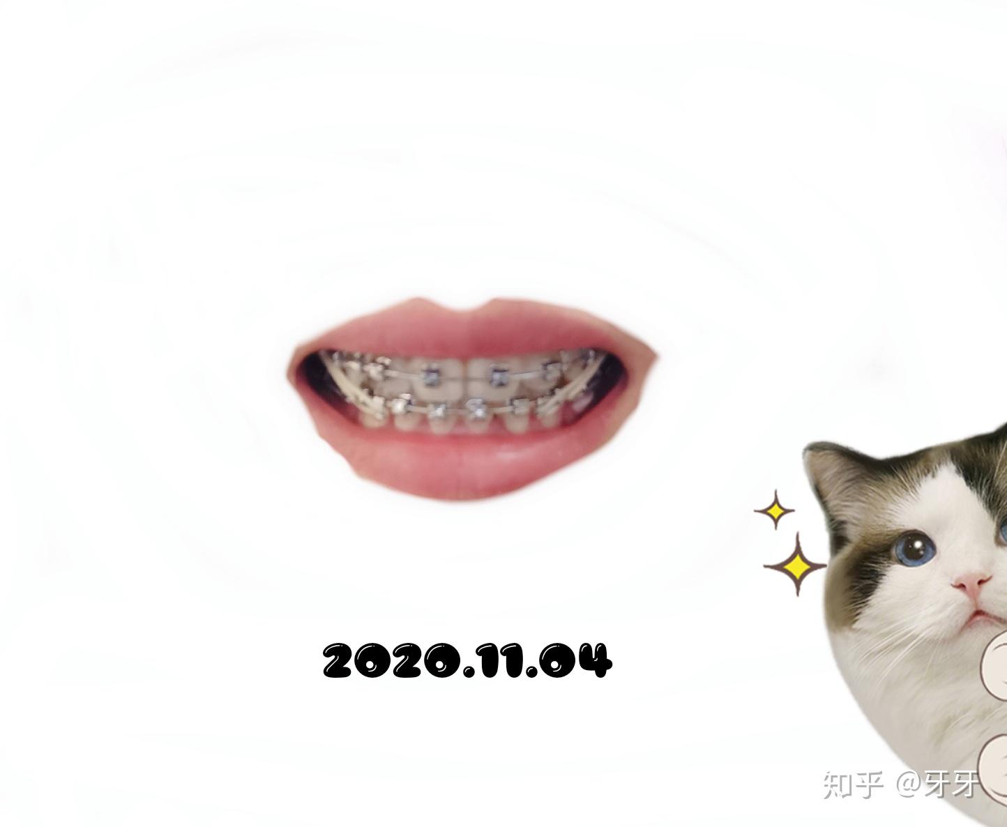 完结啦~~28岁拔牙打骨钉正畸,舌侧丝保持器记录贴,详尽的整牙手册 - 知乎