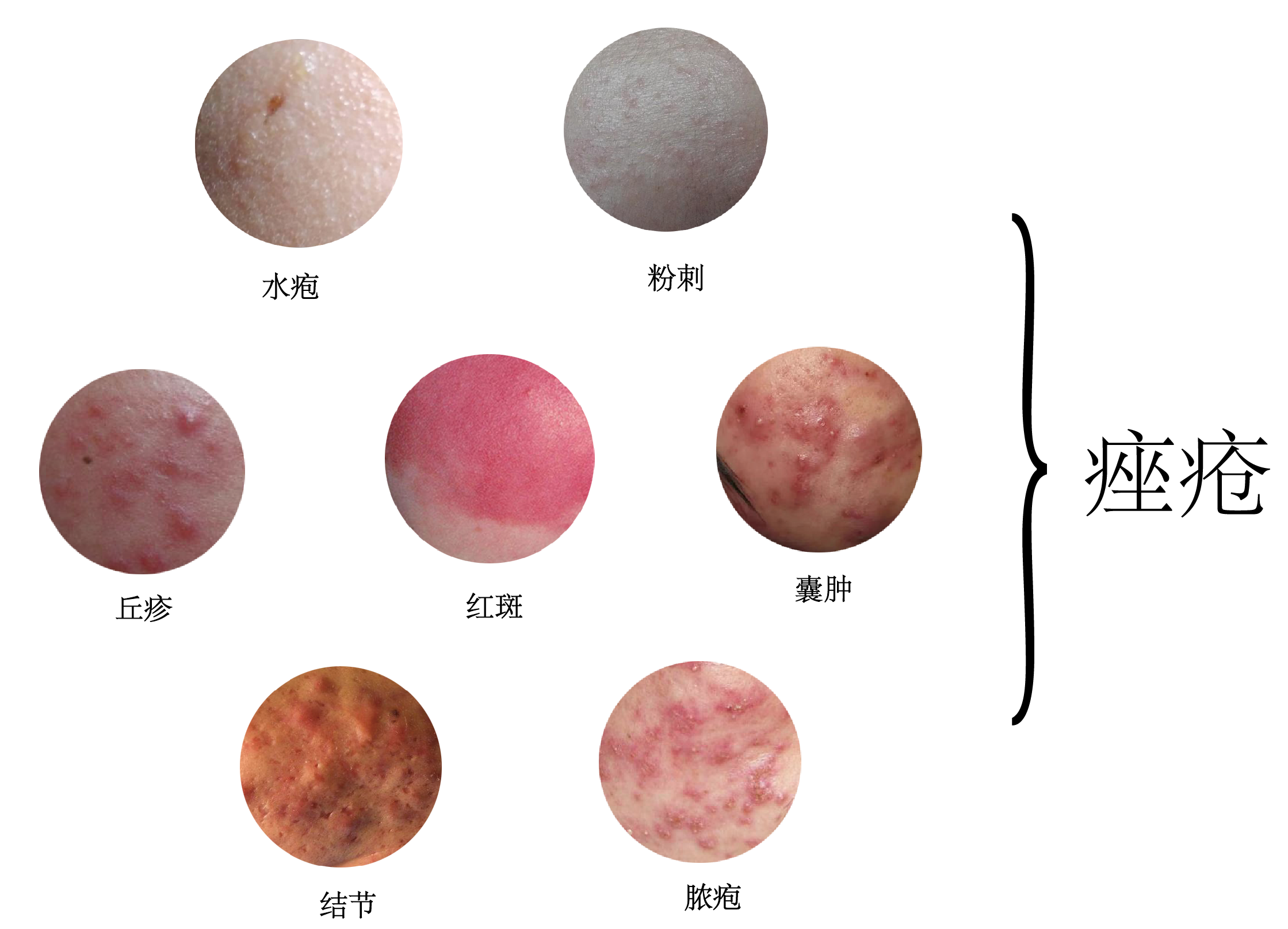 这些都可以称为痤疮而暂住菌就是那些外界环境可能会带给我们并且在