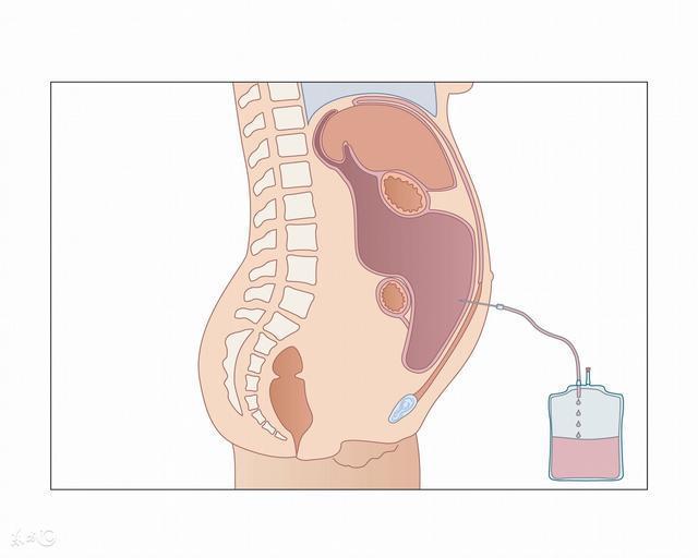 问:如今积水问题很常见:胸腔积水,肝腹水,心包积液等各种积水问搪屡