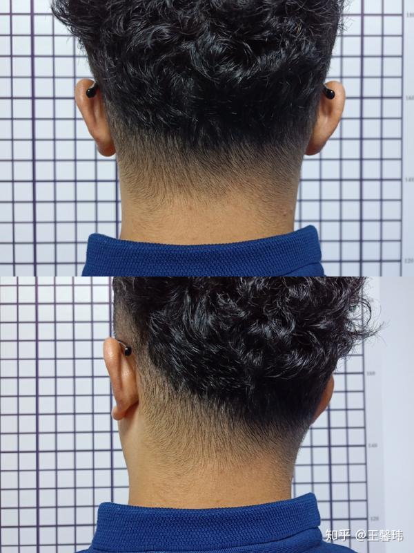 纠正:下面咱们以 头部向左旋转为例,介绍两种徒手纠正头部旋转的方法