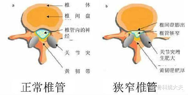 无症状的椎管狭窄需要治疗吗 骨质增生一定有害吗 医生为你揭秘 知乎