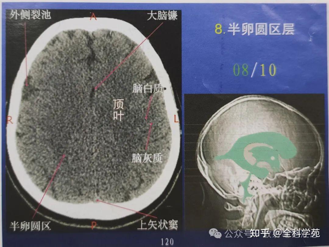 颅脑解剖、脑叶及CT表现 - 知乎