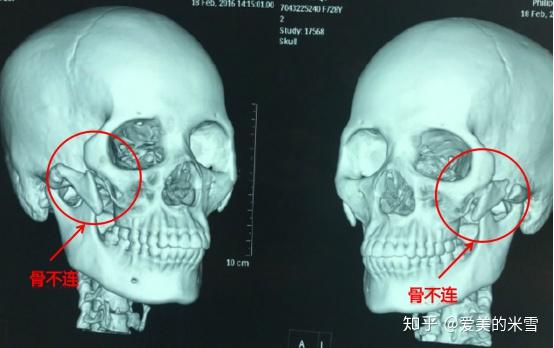 颧骨内推ct图片