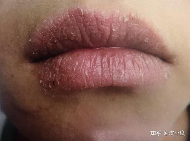 唇炎一个接吻都不可以的皮肤病