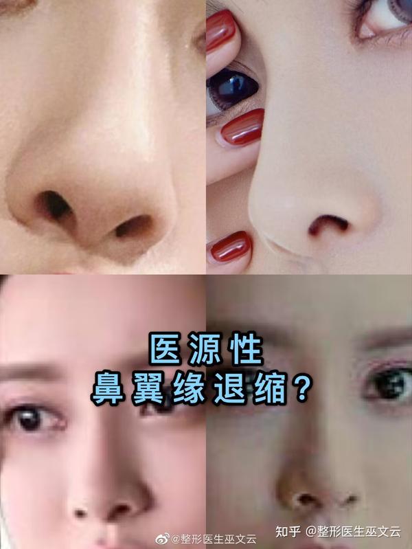 ‘朝天鼻’如何改善漏鼻孔? - 知乎