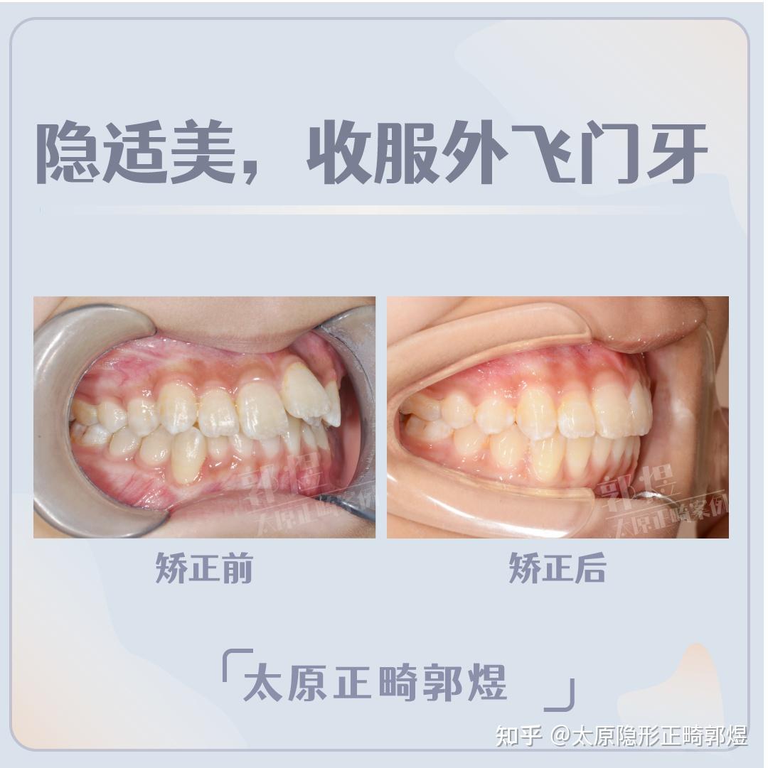 太原牙齿矫正丨牙齿不齐,门牙外飞怎么办?