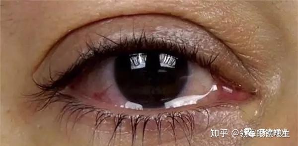 眼角下有个针眼大的小孔你知道干嘛用吗