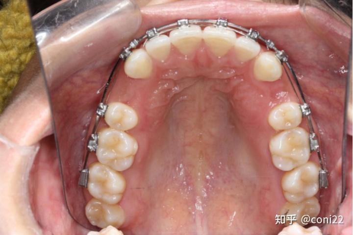 上排牙拔掉的4號牙還沒開始內收上前牙唇側基本上都沒有牙槽骨,這種