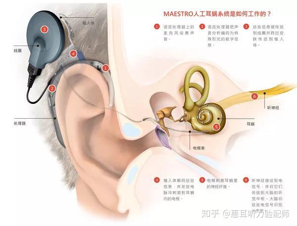 人工耳蝸基本知識二十一問二