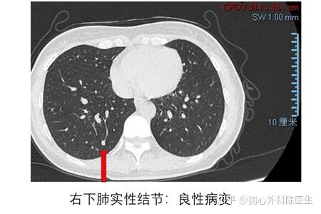 毛玻璃结节图片