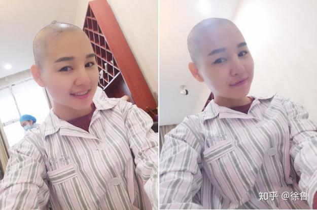 脱发,剃个光头需要多大勇气?