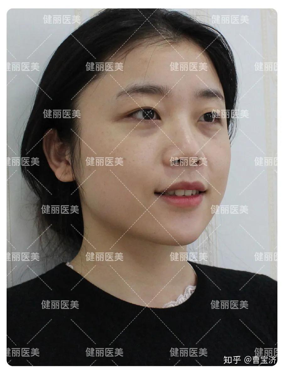 去眼袋到底難不難26歲女白領的真實體驗是