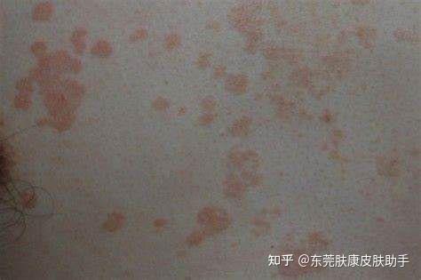 汗斑会自己褪去吗？ - 知乎