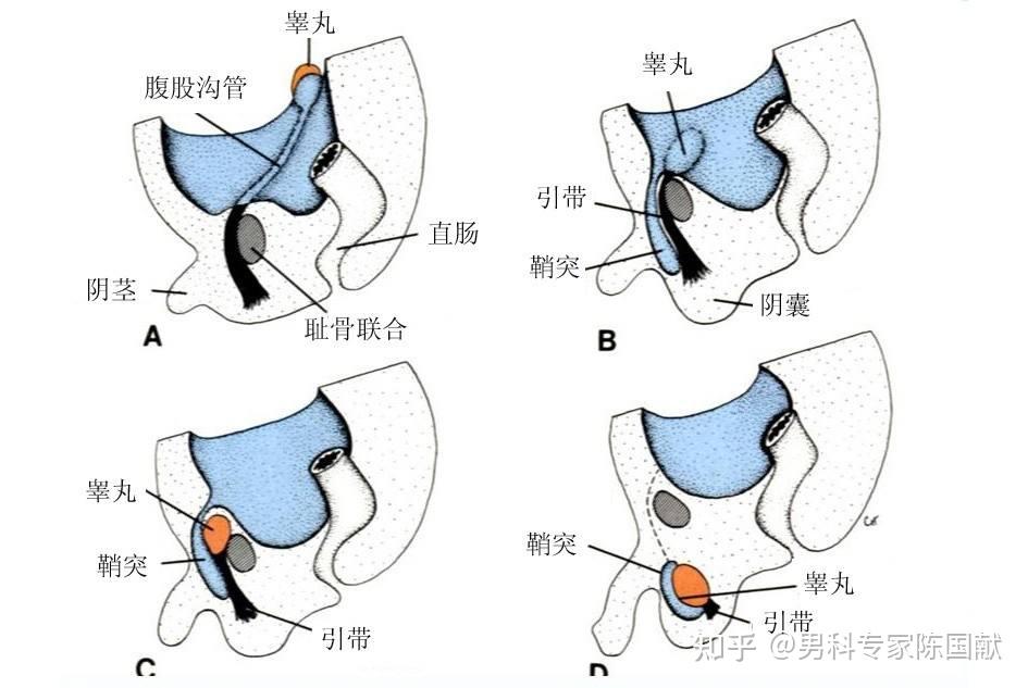 有些儿童的睾丸只能在阴囊的上方或腹股沟部摸到,称为假性隐睾或异位