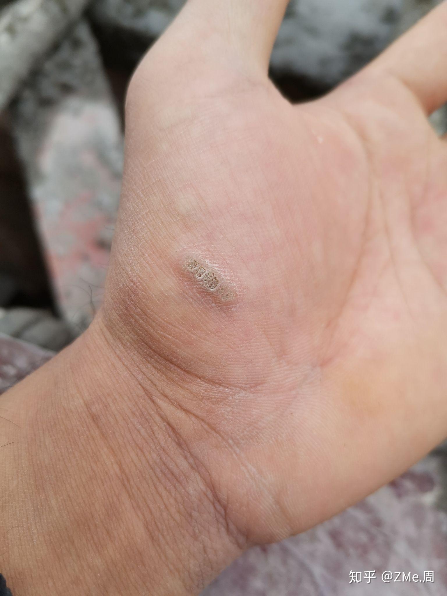 这是跖疣吗 长在手上 差不多一年了zme.周