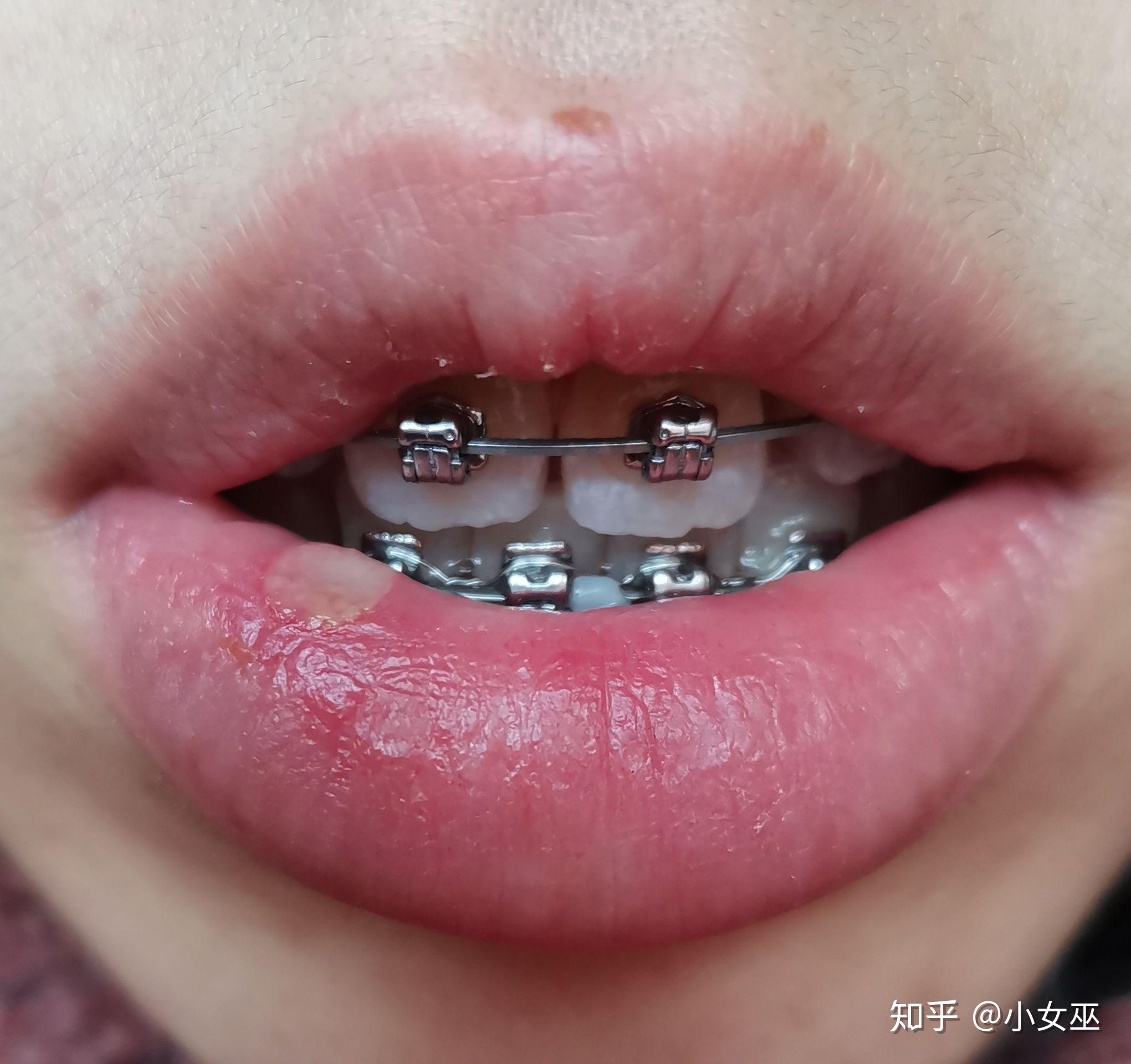 骨性嘴凸，牙齿矫正，上海口腔病防治院