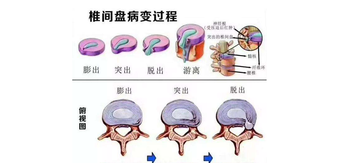 三七一治疗腰椎间盘突出三七与腰椎间盘突出