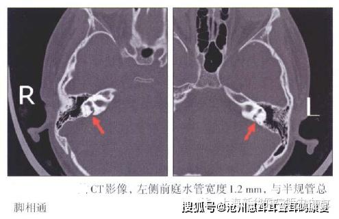 沧州惠耳教你读懂CT片——大前庭导水管综合征的CT影像学诊断 - 知乎