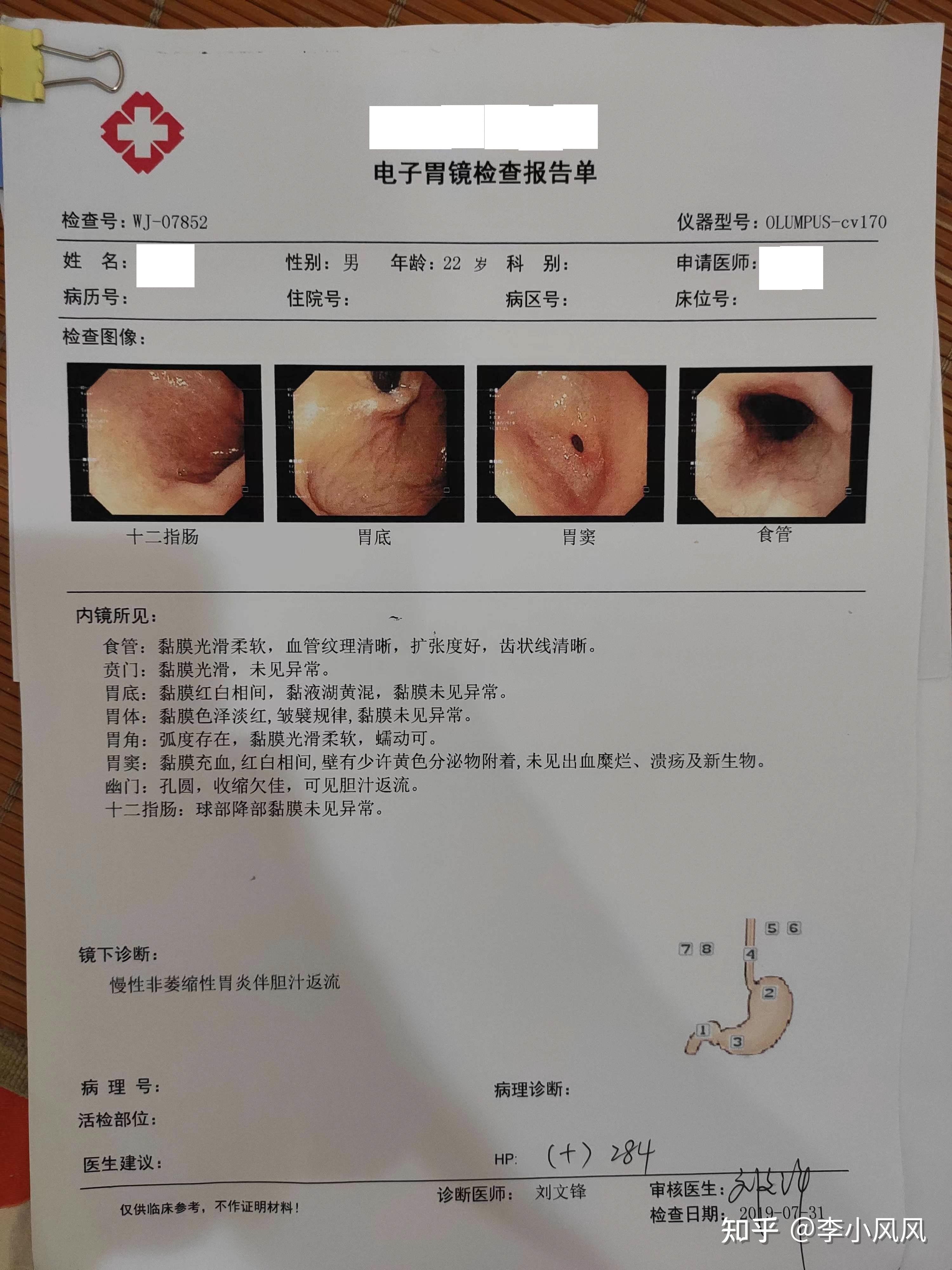 慢性浅表性胃炎伴胆汁反流康复过程