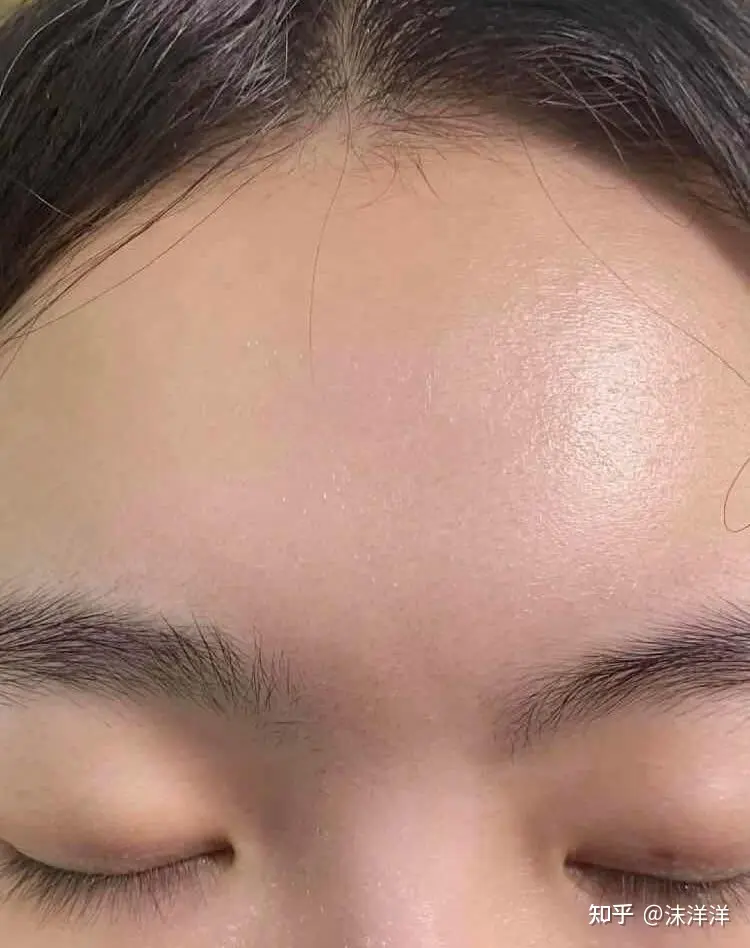 急!!额头上长闭口怎么办?