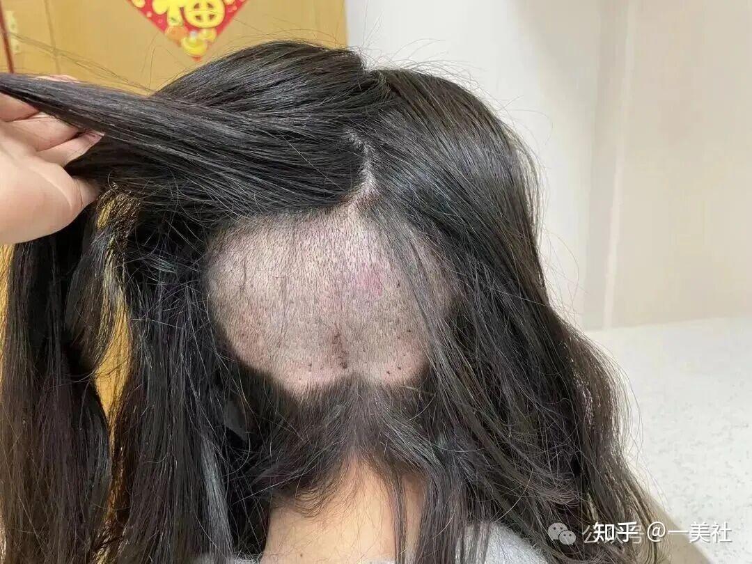 大麦植发陷多重诚信危机:承诺成活率96%实际不到50%?(图7)