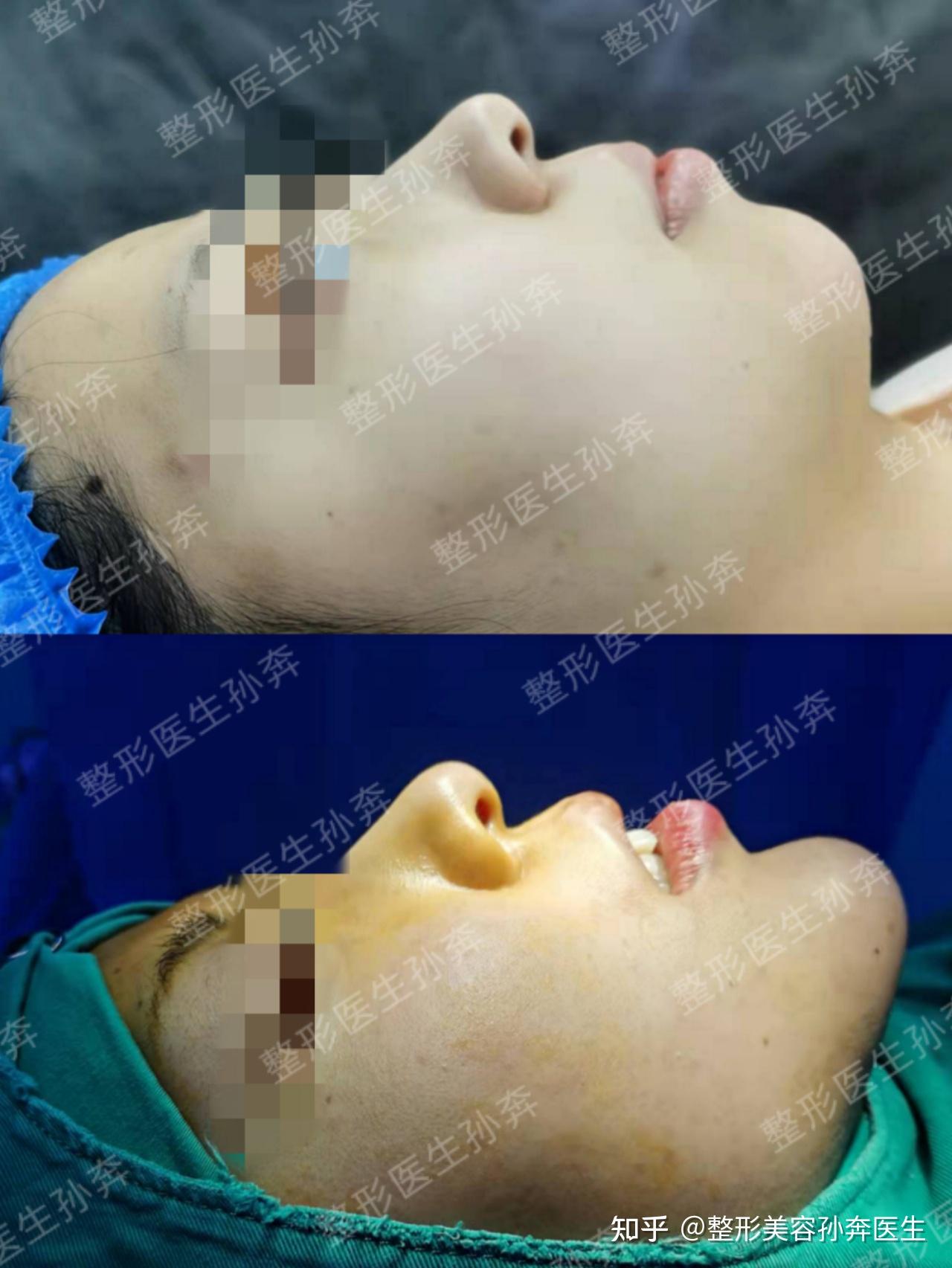 膨体下巴案例分享