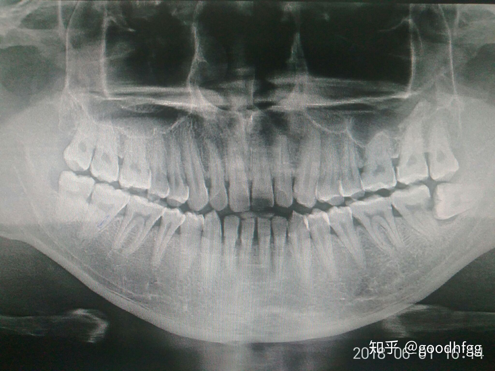 长智齿是什么原因（智齿是怎样形成的？什么年纪容易长智齿？怎样正确处理智齿呢？） | 说明书网