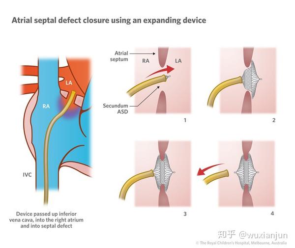 心血管内科副主任医师 67关注房间隔缺损 5 天前 最近病房收住院一
