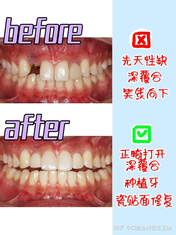 先天性牙缺失,该如何拯救? - 知乎