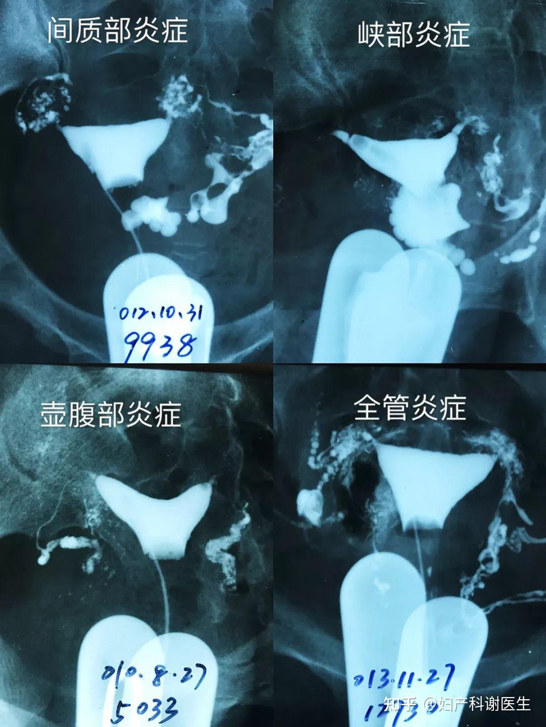 子宫输卵管碘油造影术:小手术解决输卵管的大问题! - 知乎